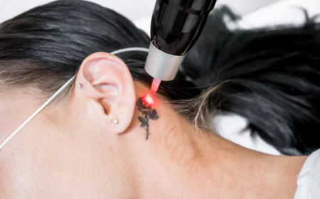 Tattoo Removal in Bangalore: Understanding Laser Treatment, Sessions and Aftercare
