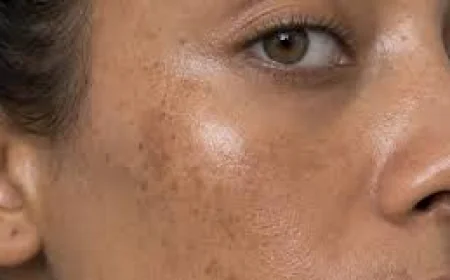 Melasma Treatment in Singapore: Is Laser Safe and Effective?