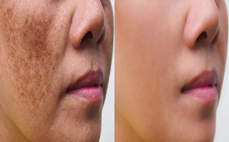 Skin Brightening and Pigmentation Treatment in Dubai | Glamorous Clinic Dubai