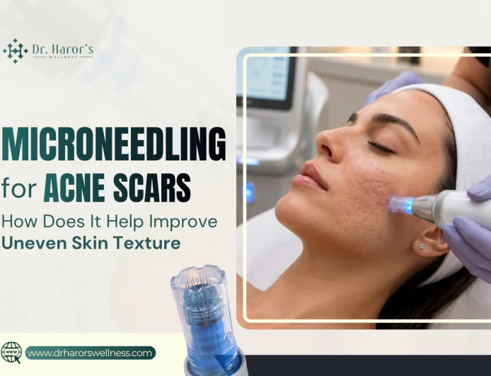 Microneedling for Acne Scars: How Does It Help Improve Uneven Skin Texture?