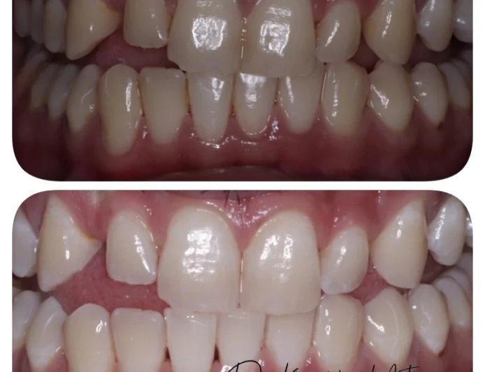 Teeth Whitening in Kalyan: Why Results May Vary
