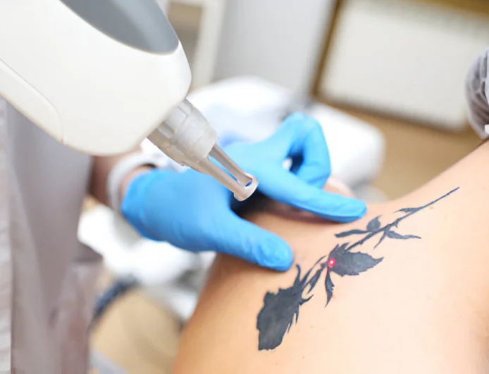 What Makes Picosure Tattoo Removal So Effective?