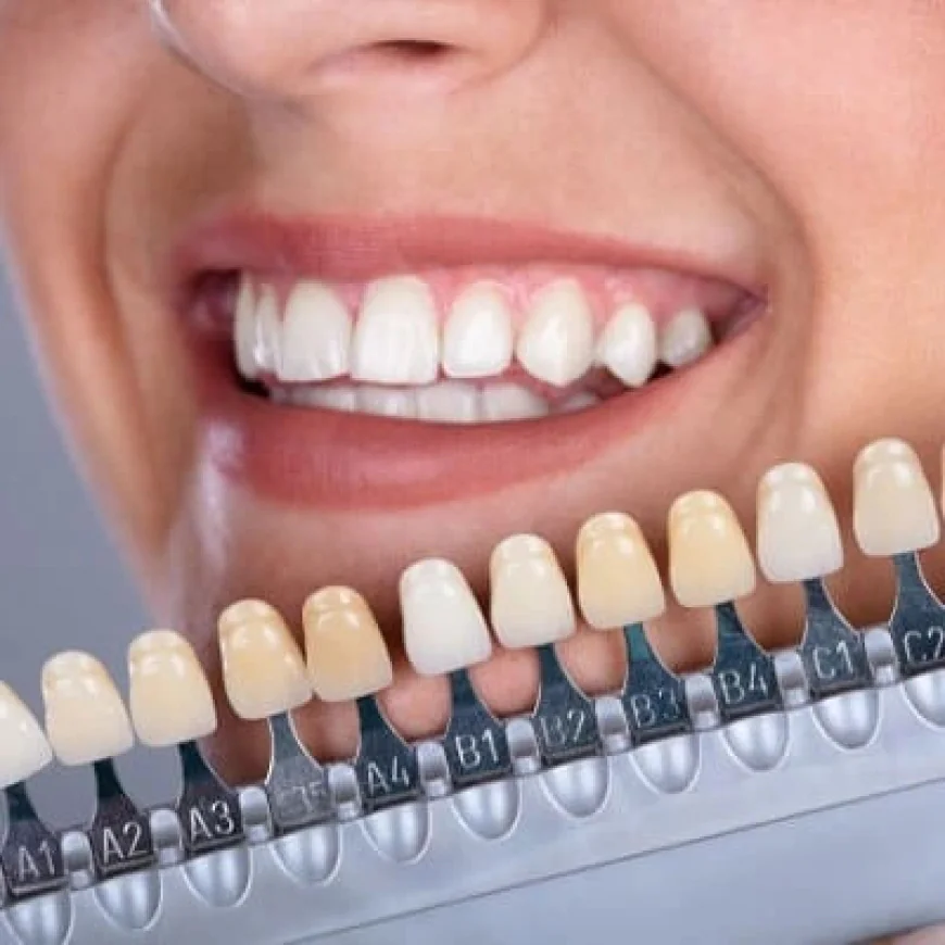 How to Choose Dental Veneers in Dubai & Abu Dhabi | Glamorous Clinic Dubai