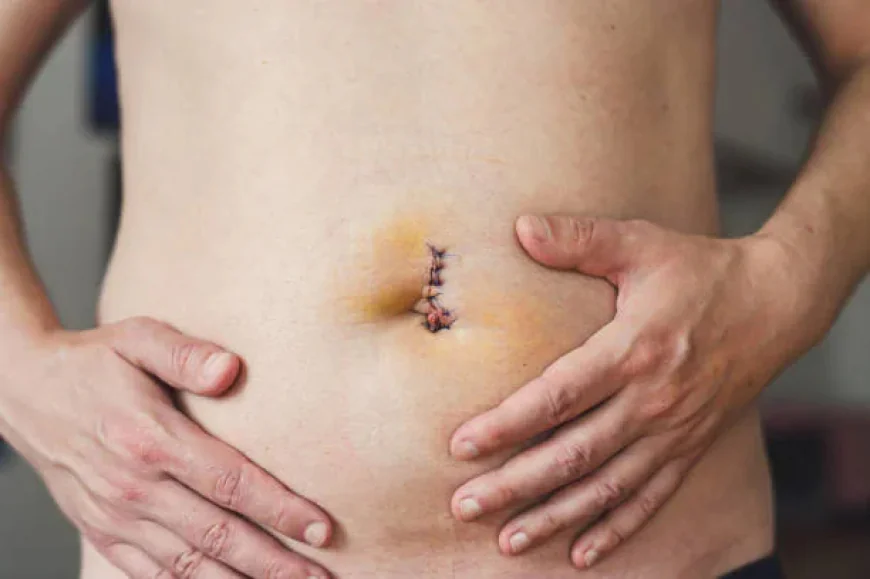 How Does Skin Lesion Removal Treat Skin Tags?