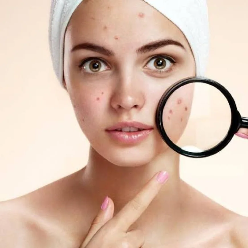 Acne Scar Removal in Dubai - The Layers Between the Scar and the Skin