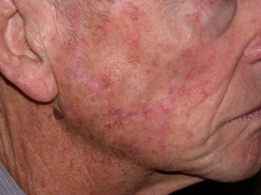 Does Actinic Keratosis Treatment Work on the Face