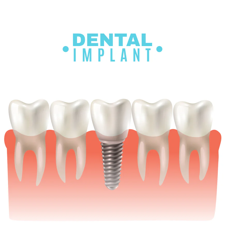 Top Questions to Ask a Dental Implants Surgeon in Indore