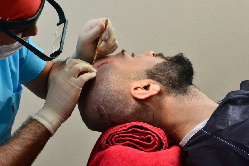 Can a Hair Transplant Improve Hair Coverage in Photographs?
