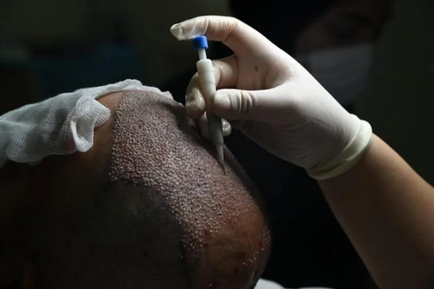 What Should You Ask About Hair Transplant Cost Before Treatment?