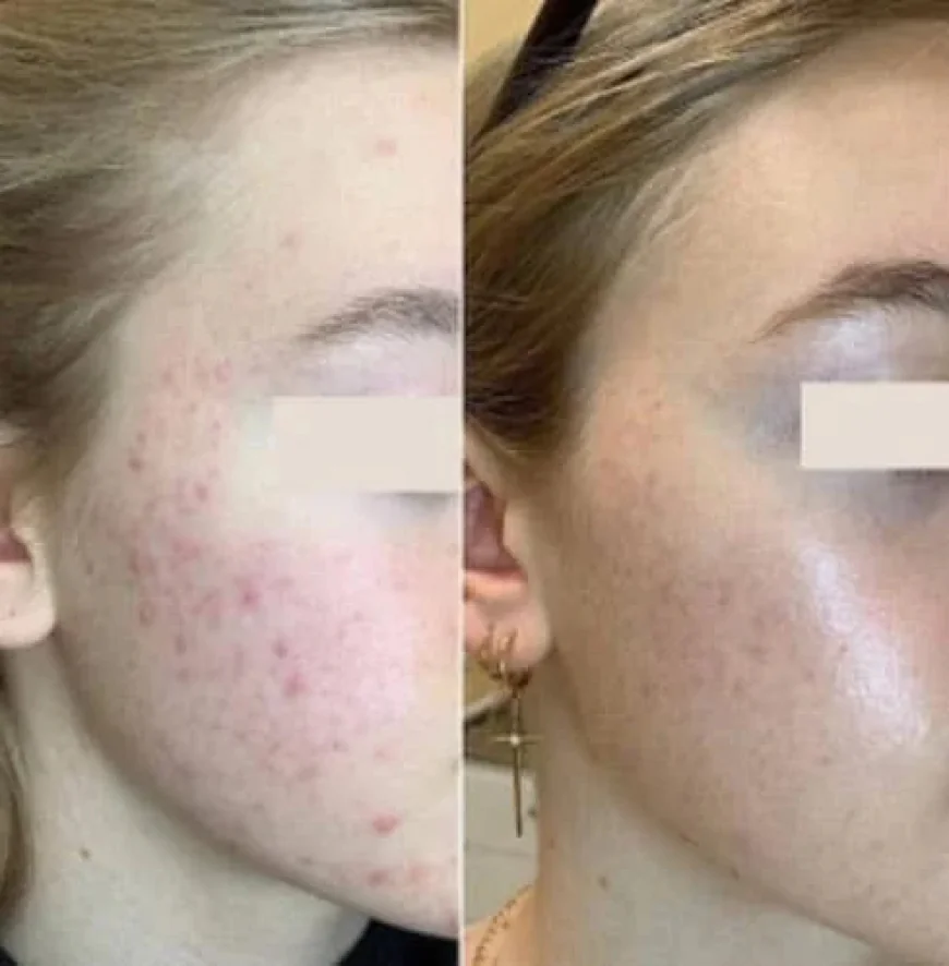 Discovering Non-Surgical Facial Rejuvenation with Liquid Face Lift and Aptos Thread Lift