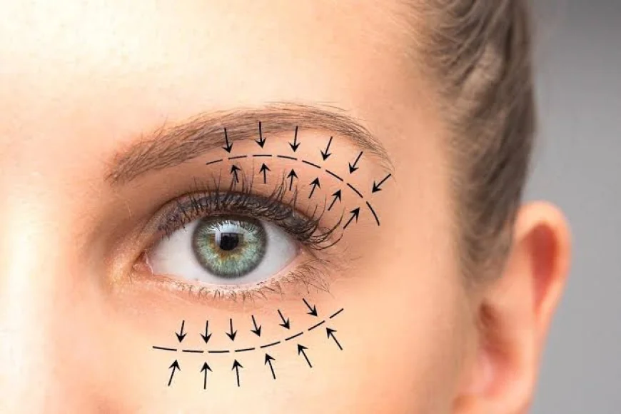 Upper Blepharoplasty In Dubai: Refresh And Define Upper Eye Contours
