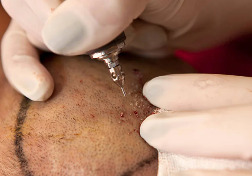 Why the Scalp Becomes More Visible with DHI Direct Hair Implant in Dubai