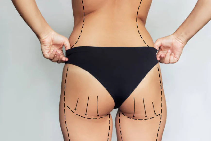 Can Liposuction improve waist-to-hip proportions