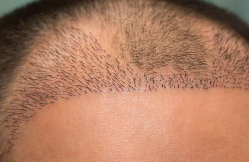 Sideburn Hair Transplant in Dubai Hair Matching Guide