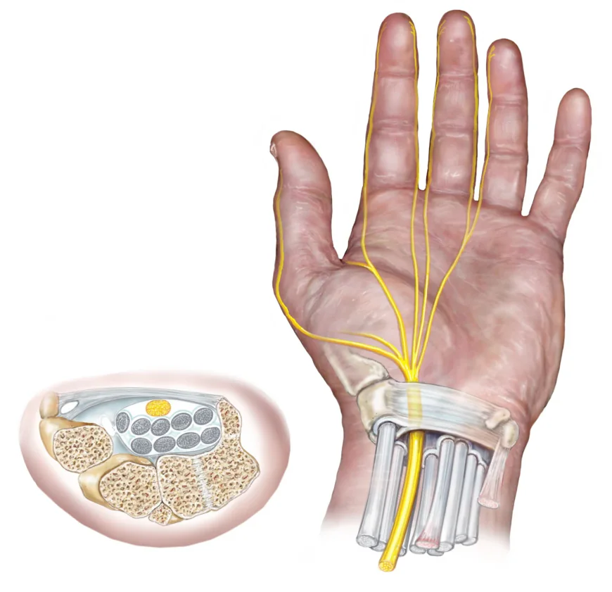 Carpal Tunnel Syndrome: When Wrist Pain Needs Medical Attention?