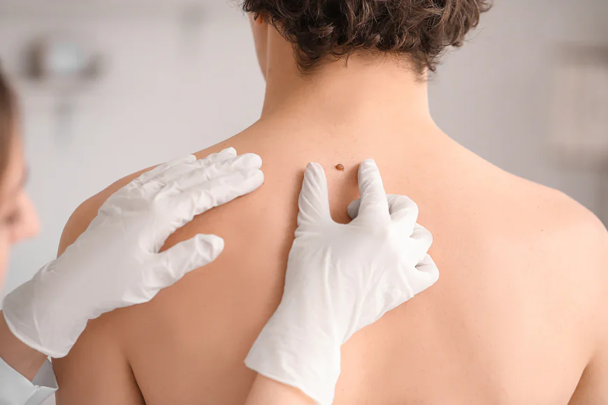 Is Moles Removal Suitable for Moles With Uneven Appearance?