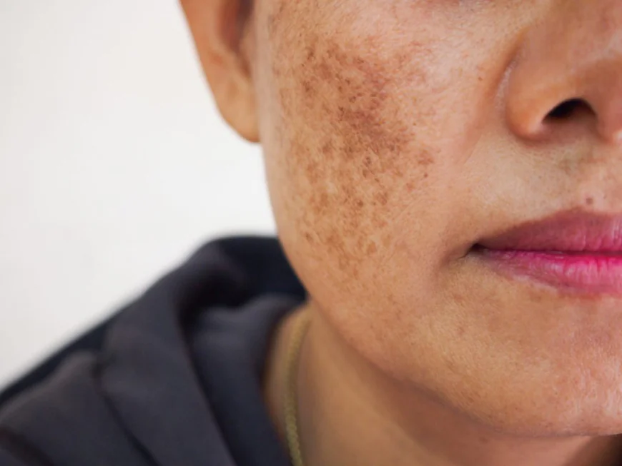 What Causes Skin Pigmentation and When Is Treatment Needed?
