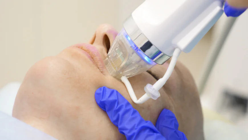 How Often Should You Get RF Micro Needling