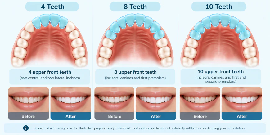 How Many Veneers Do You Need? Understanding the 4, 8 and 10 Veneer Approach