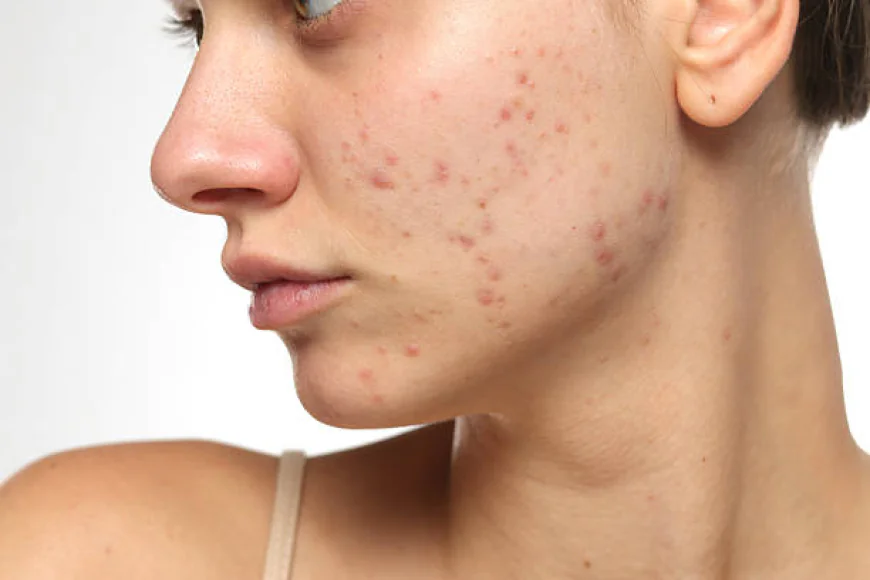 Does Laser Acne Scar Treatment improve rough facial skin