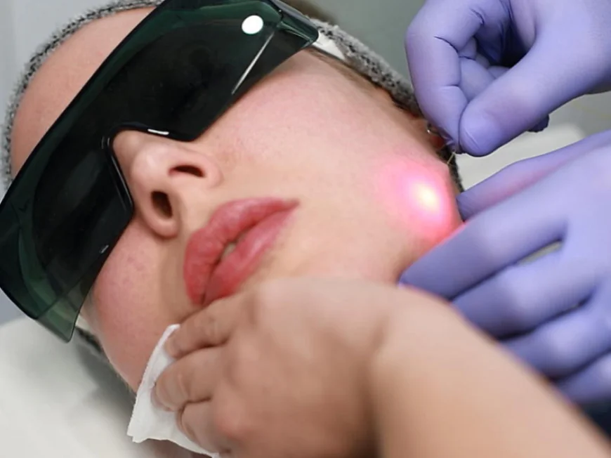 How Should You Prepare for EndoLift Treatment?