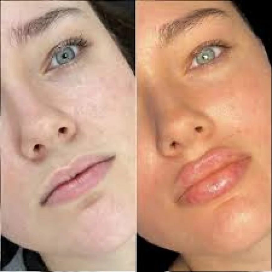 Dermal Filler Ingredients: The Difference Between Hyaluronic Acid, Radiesse, and Ellansé