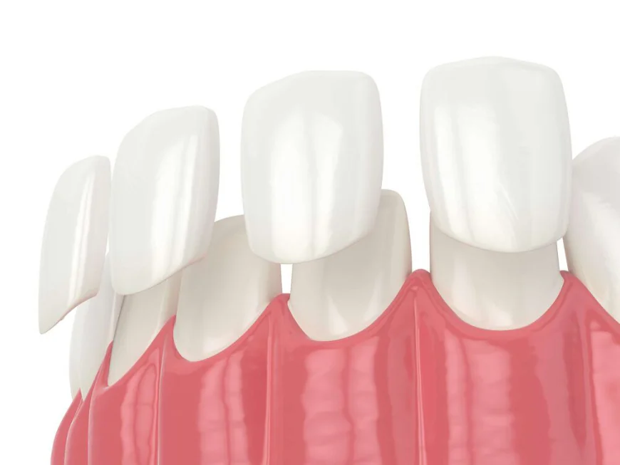 How Dental Veneers Can Improve Your Smile Aesthetics