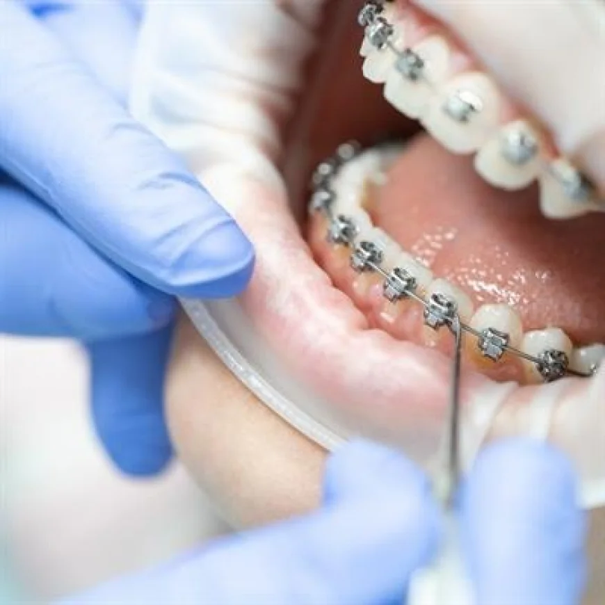 Can Braces Help With a Deep Bite?