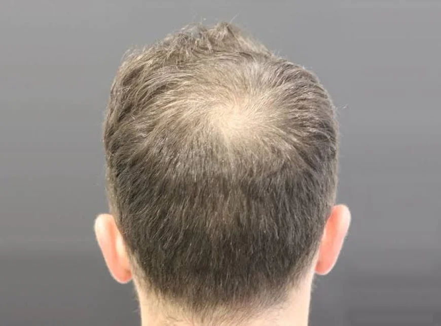 How Is Crown Hair Transplant Performed Step by Step?