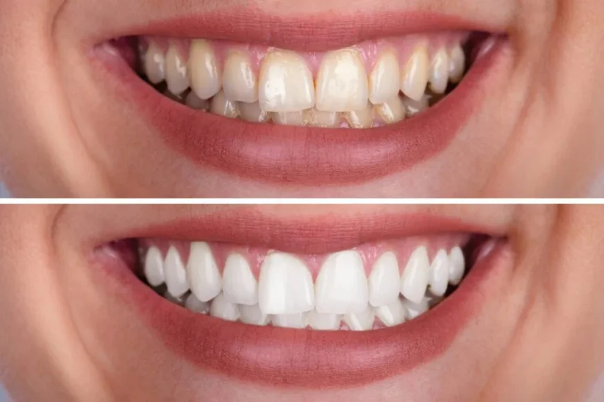 Professional Whitening vs. Store-Bought Kits: What Actually Works