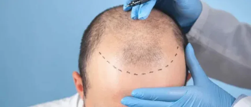 Could DHI Help Restore Your Hair?
