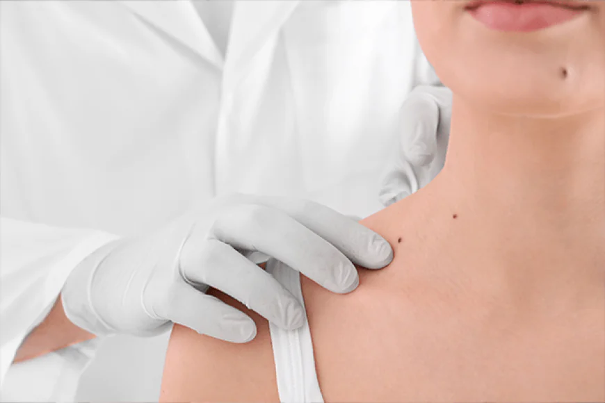 Does Mole Removal Work on Dark Skin Moles?