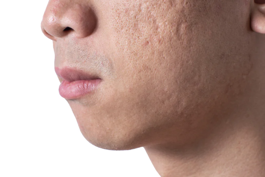 How Does Subcision Treatment Help With Deep Facial Scars?