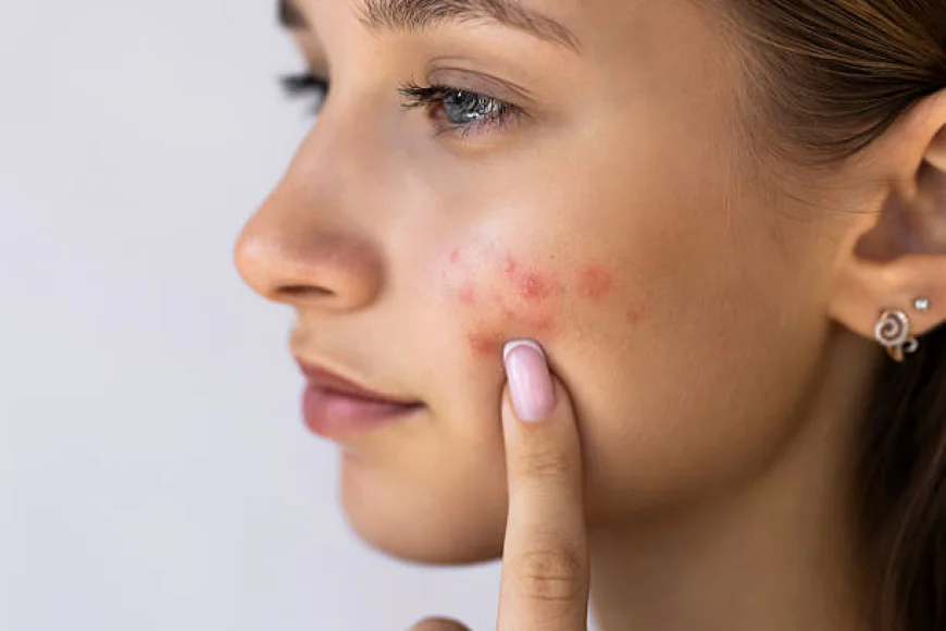 Can Acne Treatment Improve Acne-Prone Skin Texture