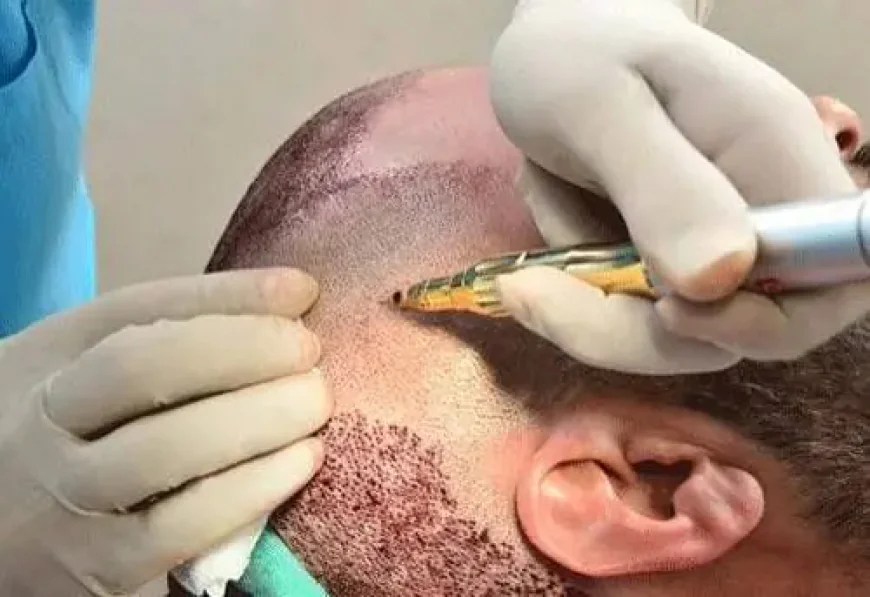 Discover Personalized Hair Transplant Treatments