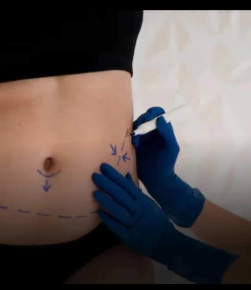 Abdominoplasty In Dubai: Create A Sleek And Defined Abdominal Profile
