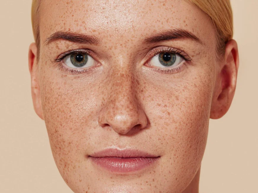Why Does Facial Pigmentation Develop Over Time?
