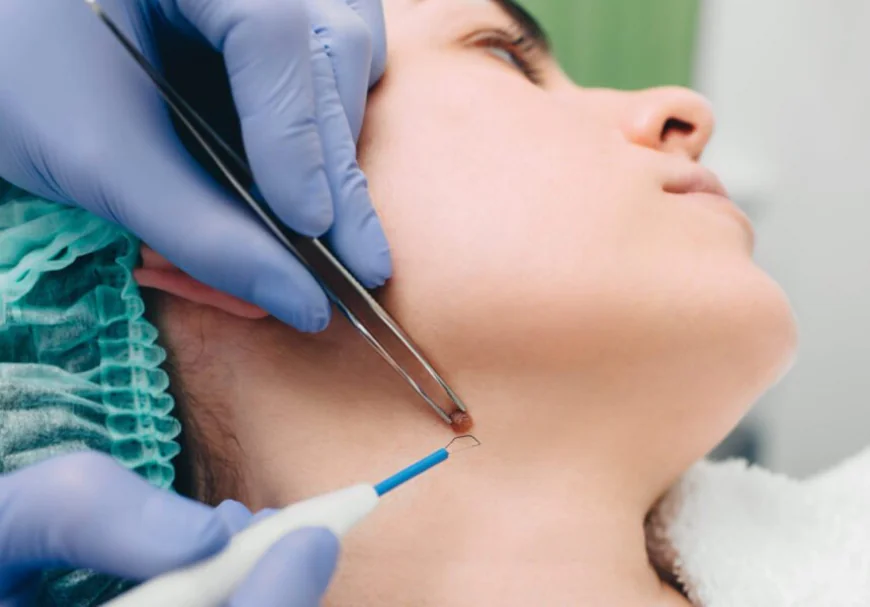 How Can Mole Removal Help Improve the Look of Facial Skin?