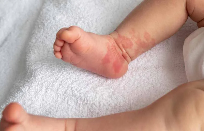 Best Birth Mark Removal Treatment in Guwahati – Personalized Skin Solutions with Advanced Laser Technology | Essence Skin Care