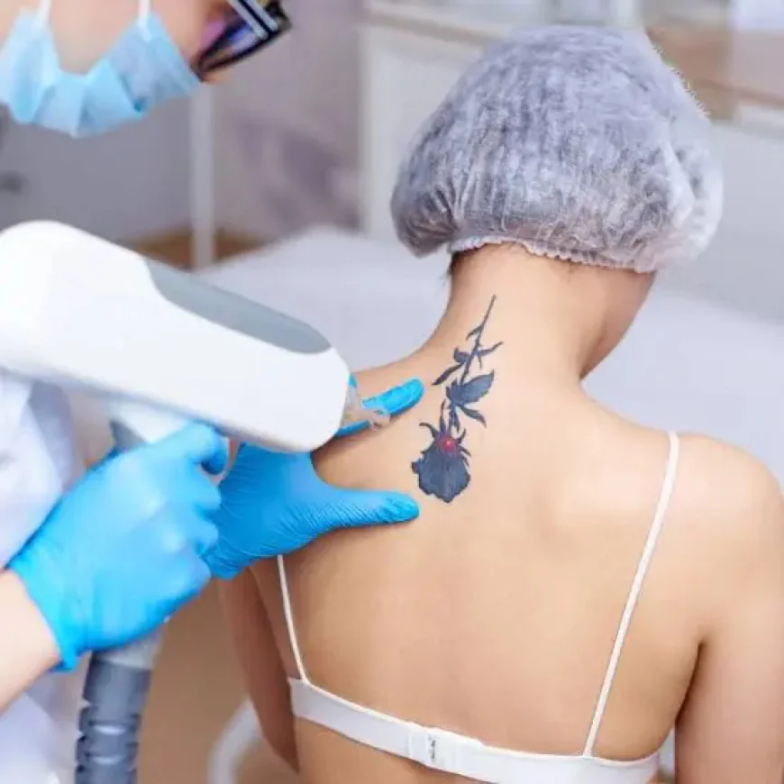 Is Laser Tattoo Removal Effective for Old Tattoos?