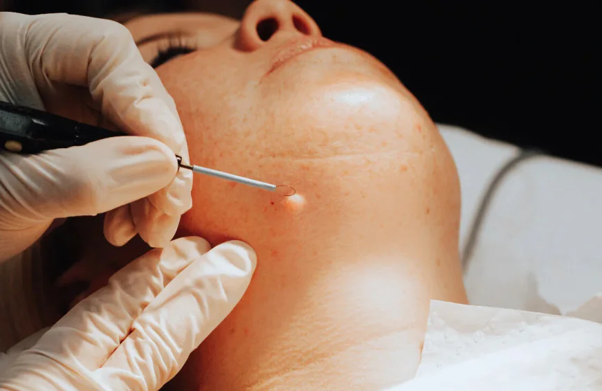 How does Skin Lesion Removal address selected skin concerns?