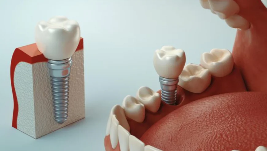 The Lifelong Benefits of Choosing Dental Implants for Tooth Replacement