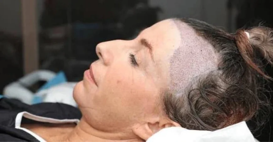 Discover Personalized Hair Restoration with FUE Hair Transplant