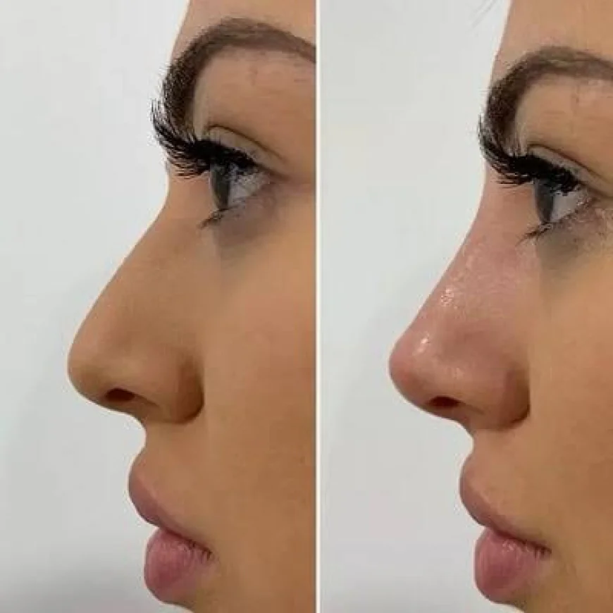 Rhinoplasty in Islamabad: A Complete Guide to Nose Surgery