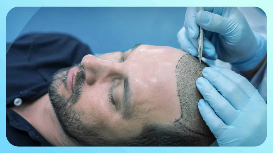 Planning a Hair Transplant in Gurgaon? Start With These Essential Facts