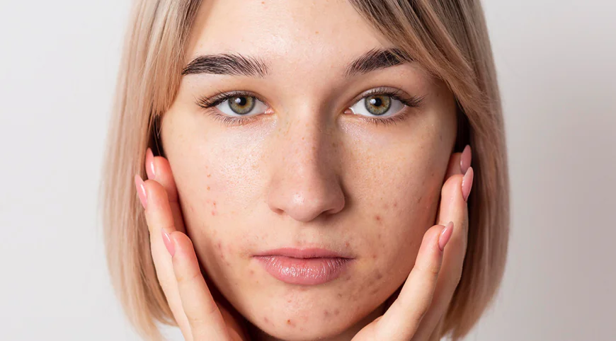 Does Laser Acne Scar Treatments Work on Old Scars?