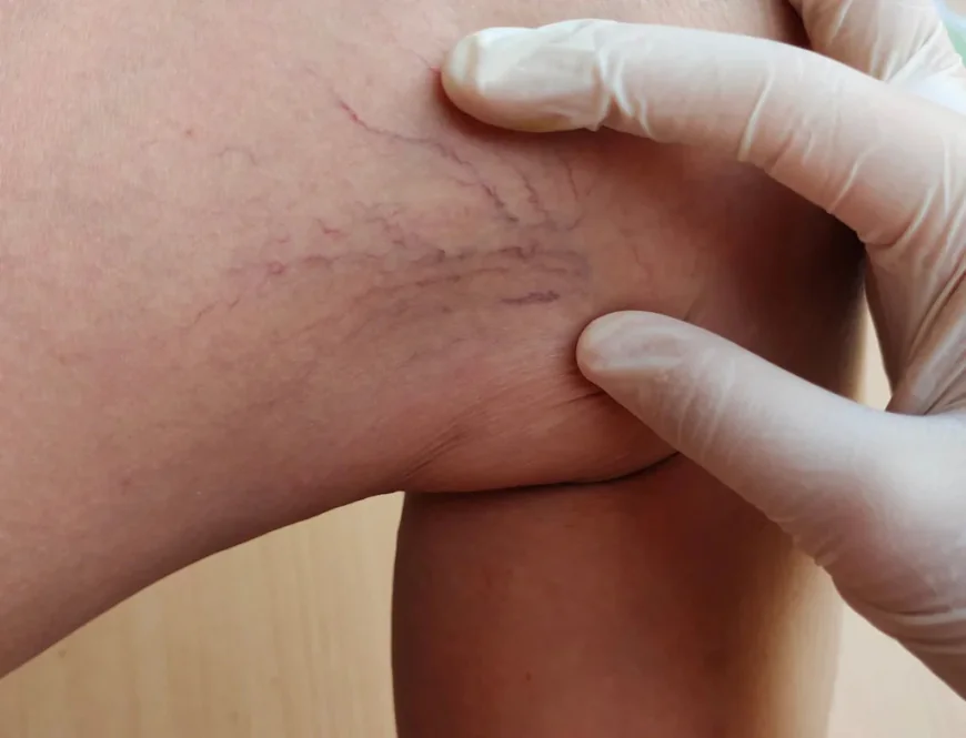 How Can Sclerotherapy Help Treat Visible Leg Veins?