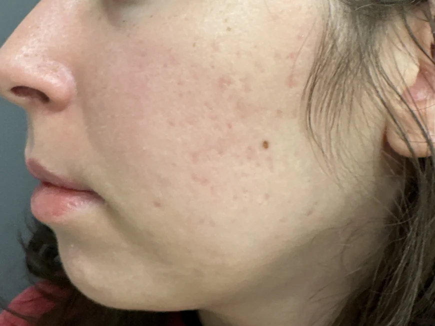 How Can Acne Scar Treatment Improve the Look of Pores?