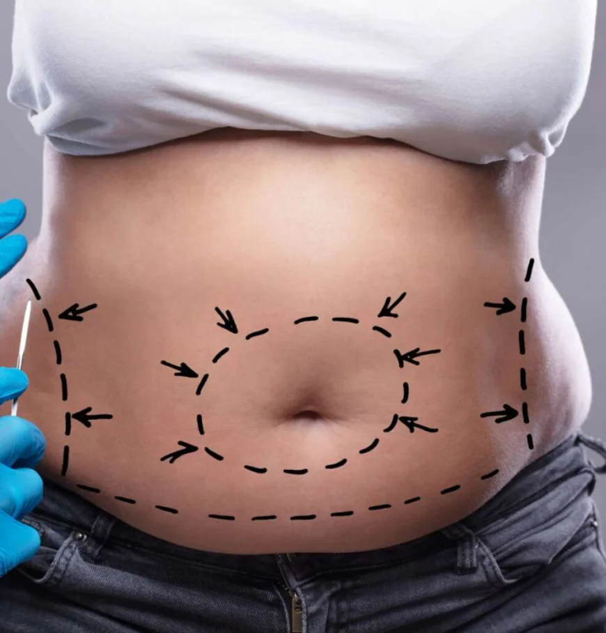 How Does Tummy Tuck Surgery Improve Abdominal Shape?