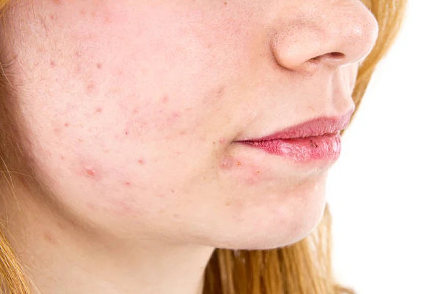 Can Acne Treatment Help Reduce Excess Skin Oil?
